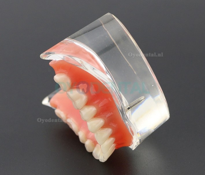 Tandentandenmodel Overdenture Inferieur met 2 implantaten Studiedemo Model 6002 01